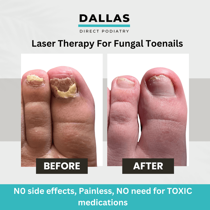 Laser Toenail Fungus Specialist Voted Best Podiatrist In Dallas, TX